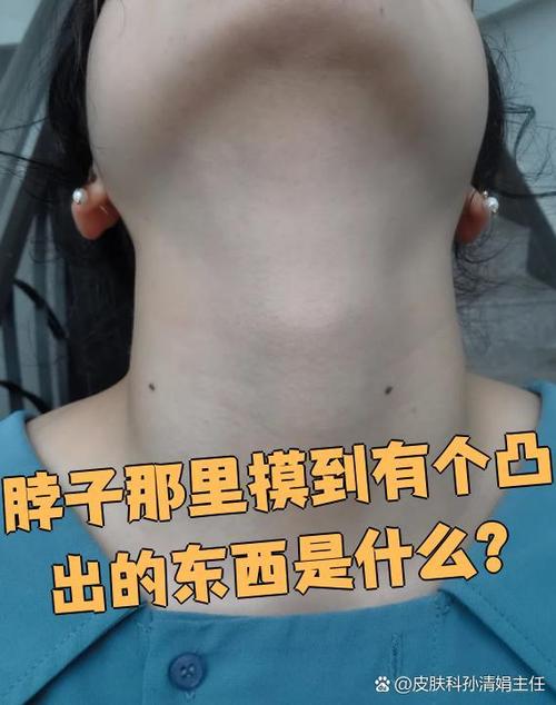 咽喉结节吃什么药可以散结图标