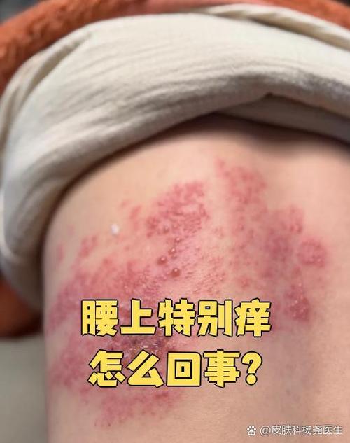 一摸腰就痒是不是虚
